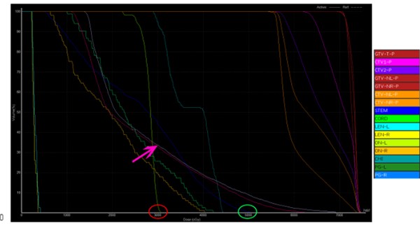 為什么說鼻咽癌TOMO治療優(yōu)于VMAT：來自臨床計劃對比實證